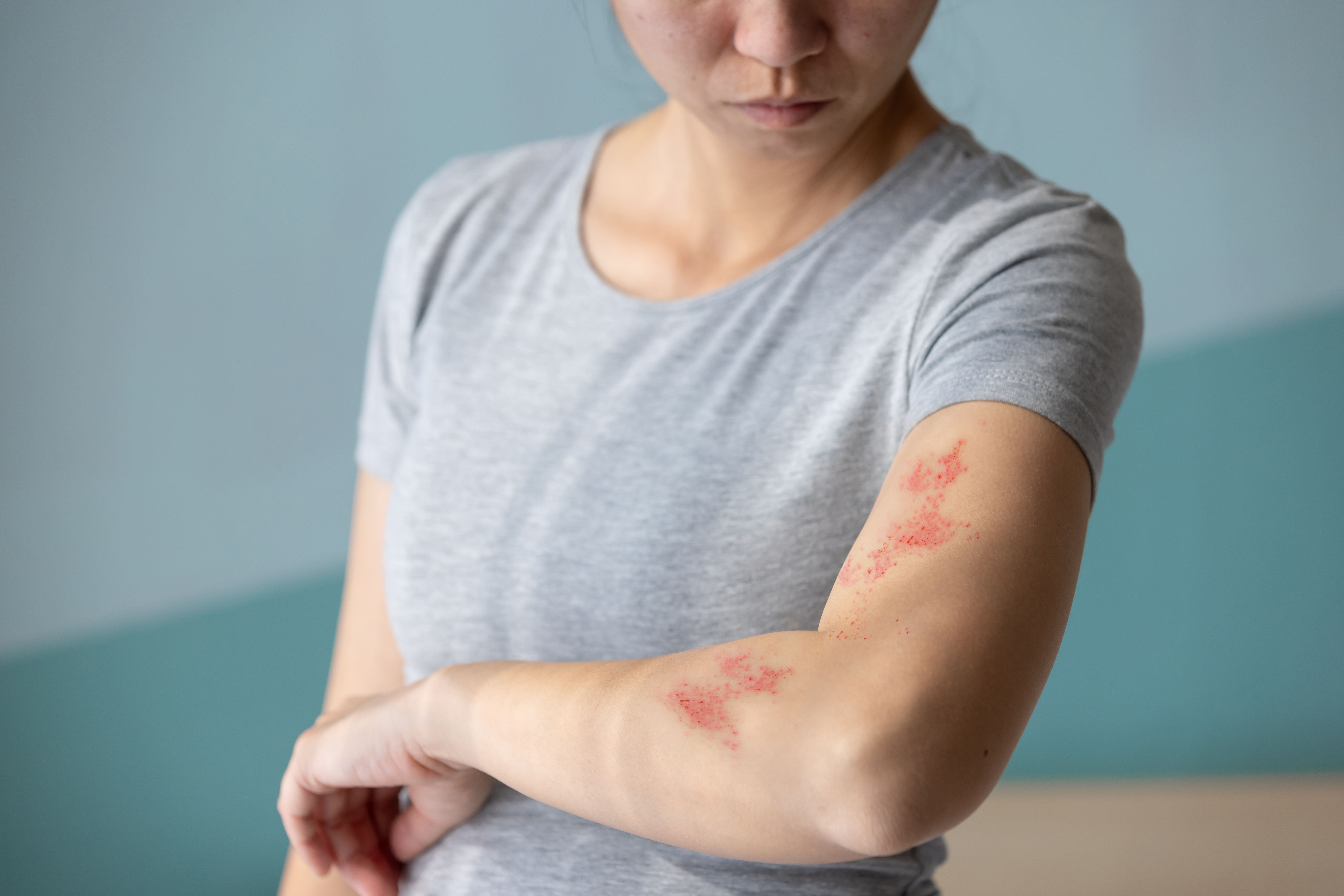 Por que o herpes zóster causa dor?